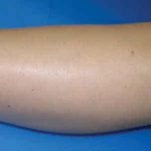Laser Hair Removal Best Near Me London Dermacure