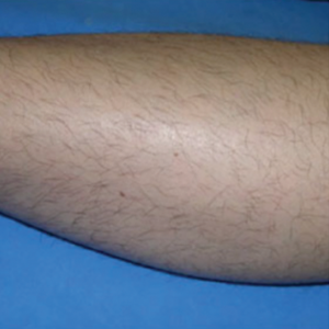 Laser Hair Removal Best Near Me London Dermacure