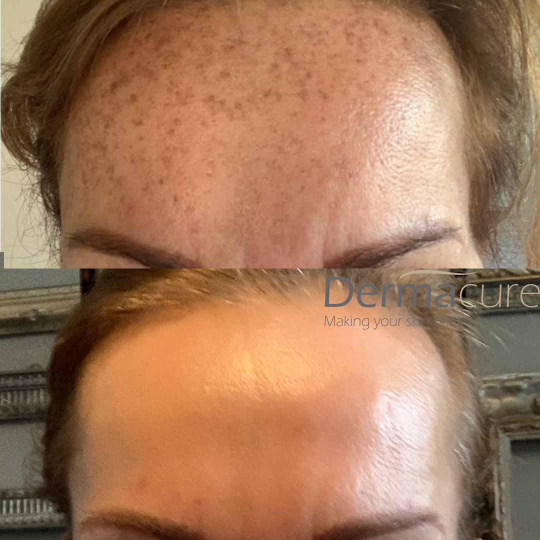 Dye VL before and after