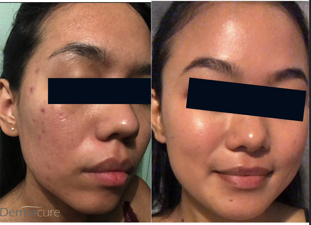 Cosmelan before and after asian skin