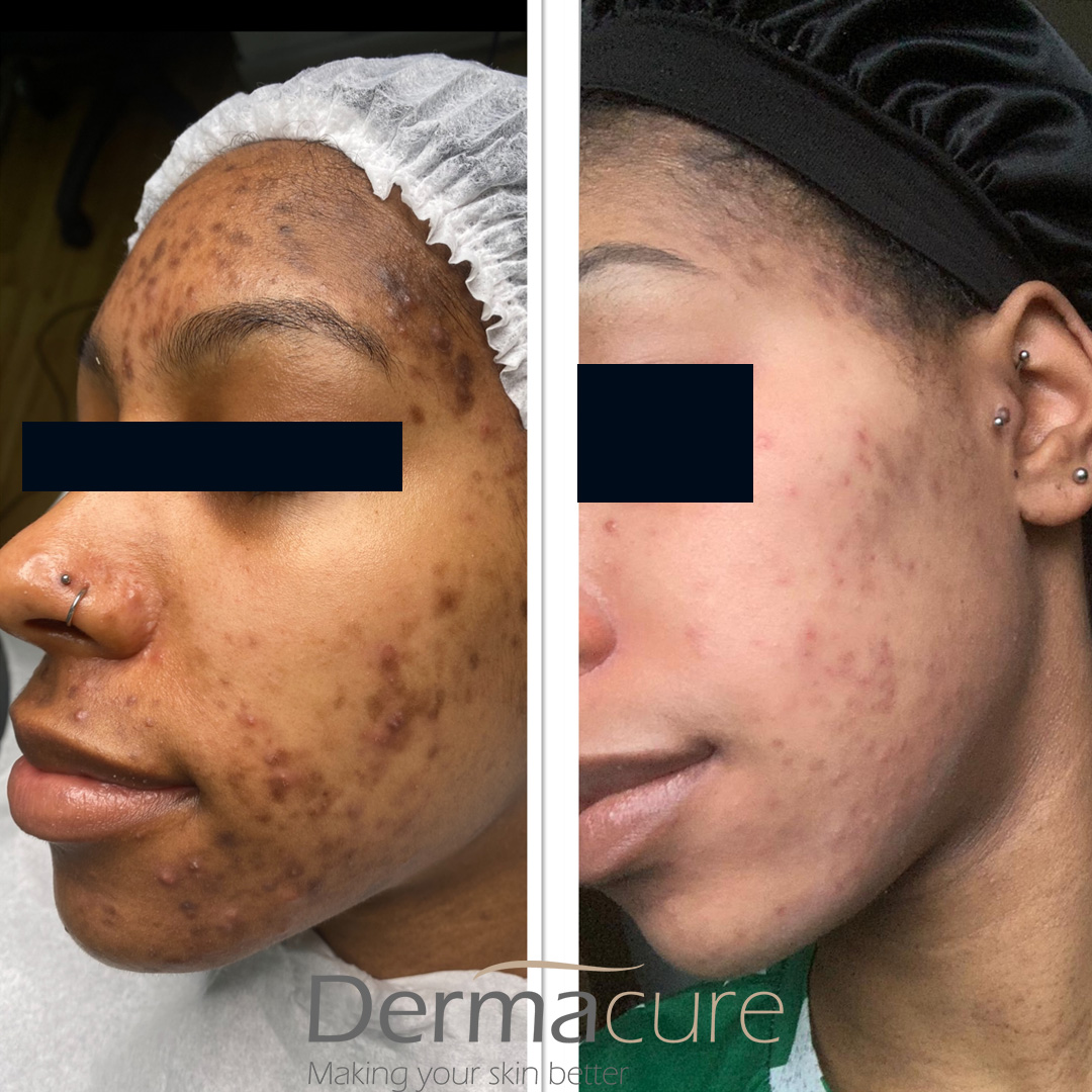Cosmelan before and after dark skin -case 1