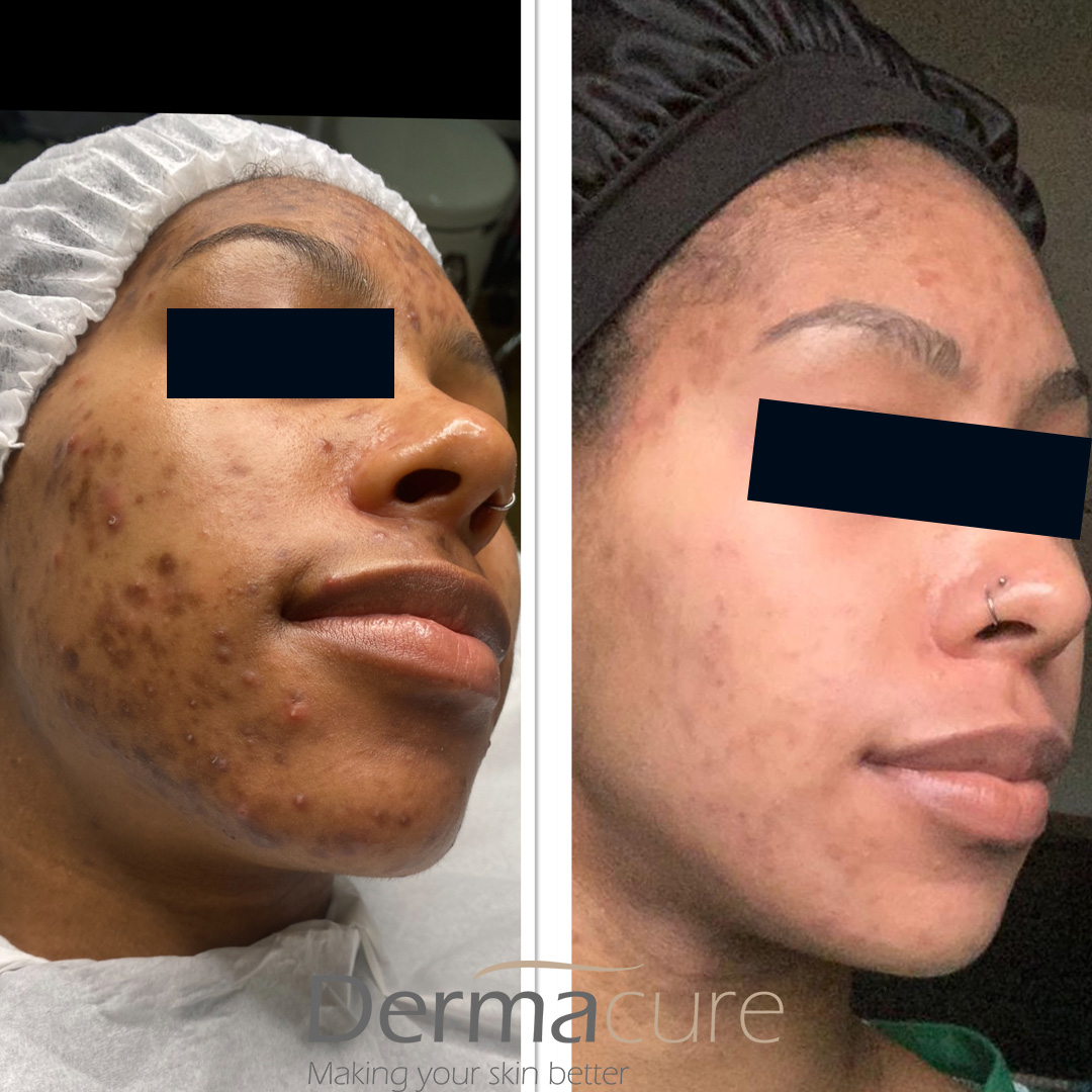 cosmelan before and after dark skin case 2