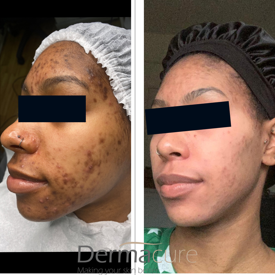 cosmelan before and after dark skin case 3